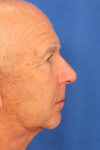 Blepharoplasty case #3951