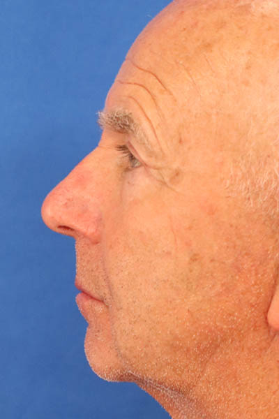 Blepharoplasty case #3951