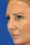 Blepharoplasty case #3964