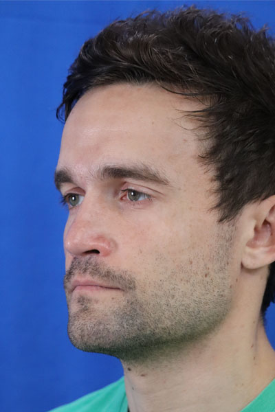 Rhinoplasty For Men case #3586