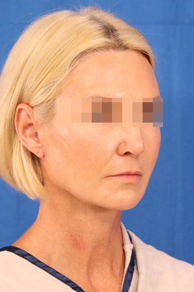 Facelift case #3728