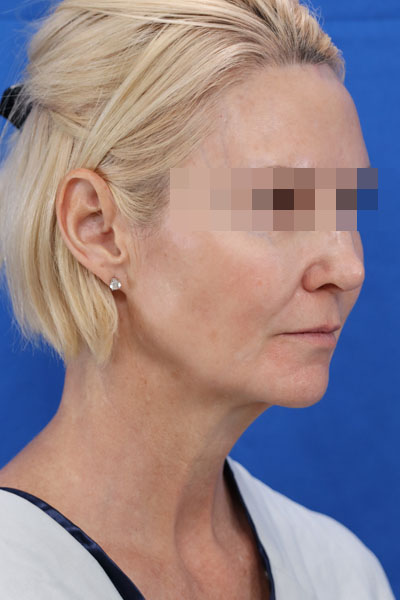 Facelift case #3728