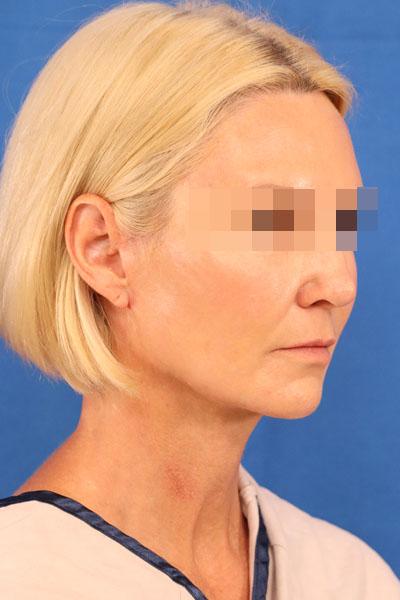 Facelift case #3728