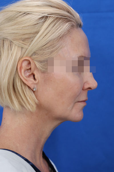 Facelift case #3728