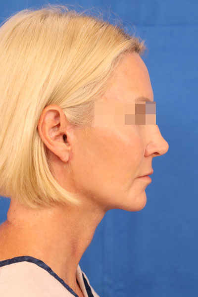 Facelift case #3728