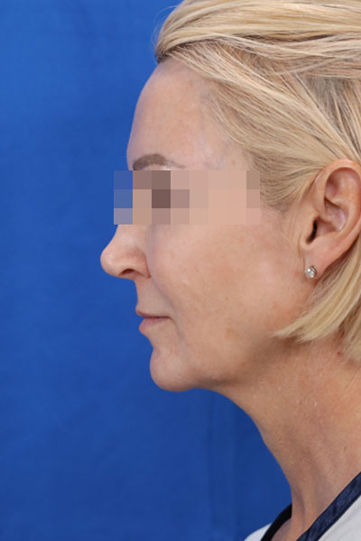 Facelift case #3728