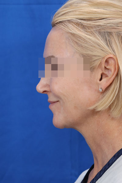 Facelift case #3728