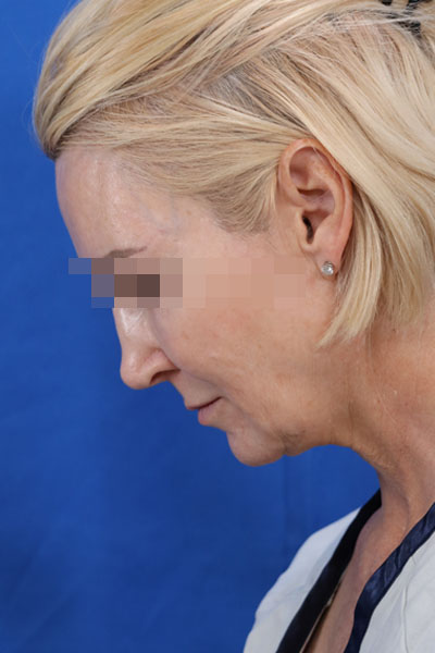 Facelift case #3728