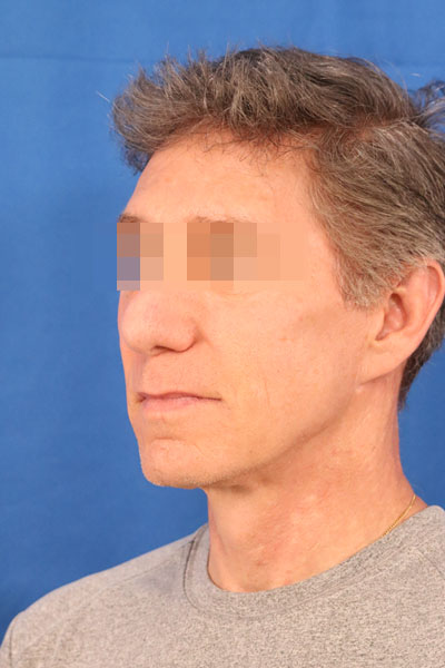 Facelift case #3671