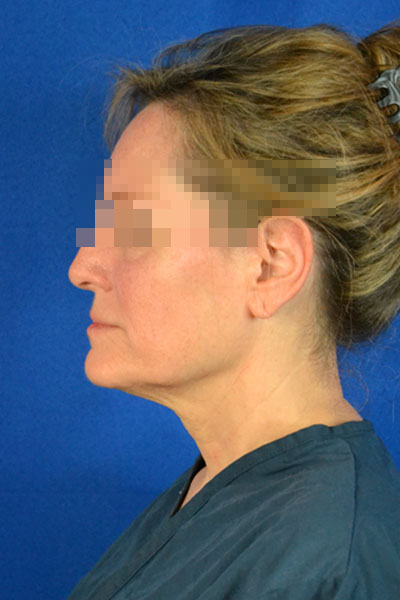 Facelift case #3833