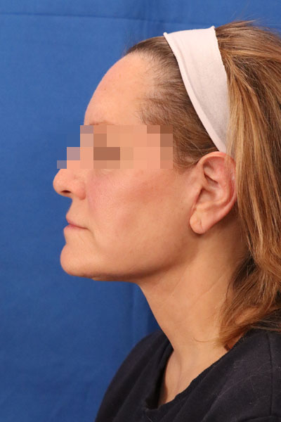 Facelift case #3833