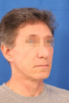 Facelift case #3671