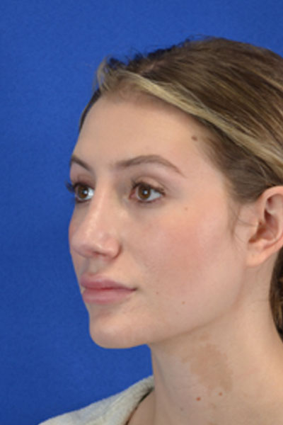 Revision Rhinoplasty case #3575