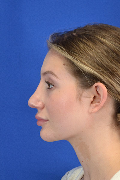 Revision Rhinoplasty case #3575