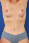 Abdominoplasty case #5167