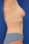 Abdominoplasty case #5167