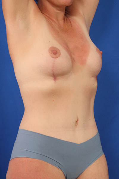 Abdominoplasty case #5167