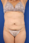 Abdominoplasty case #5185