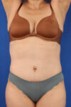 Abdominoplasty case #5185