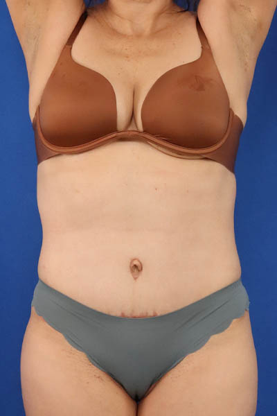 Abdominoplasty case #5185
