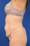 Abdominoplasty case #5185