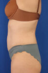 Abdominoplasty case #5185