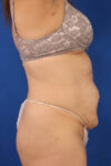 Abdominoplasty case #5185