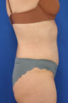 Abdominoplasty case #5185