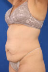Abdominoplasty case #5185