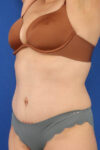 Abdominoplasty case #5185