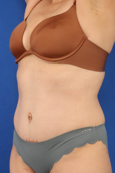 Abdominoplasty case #5185