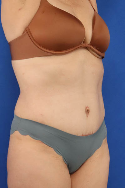 Abdominoplasty case #5185