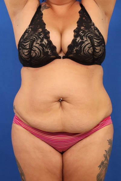 Abdominoplasty case #5196