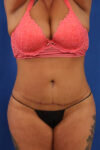 Abdominoplasty case #5196