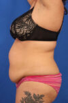 Abdominoplasty case #5196