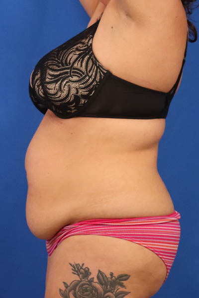 Abdominoplasty case #5196