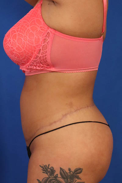 Abdominoplasty case #5196