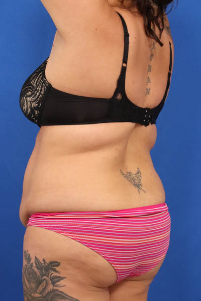 Abdominoplasty case #5196