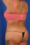 Abdominoplasty case #5196