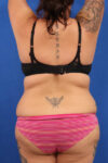 Abdominoplasty case #5196