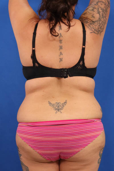 Abdominoplasty case #5196