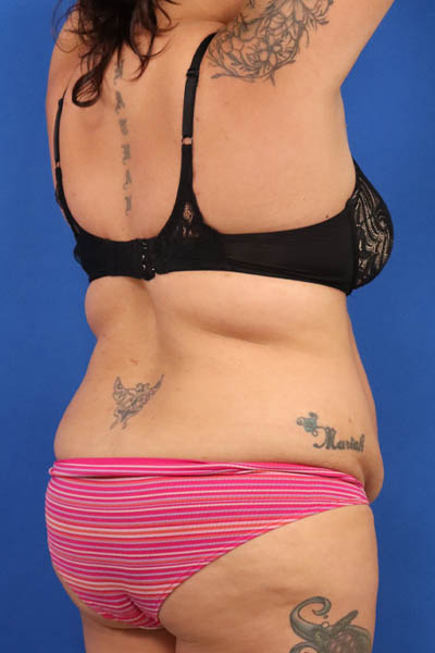 Abdominoplasty case #5196