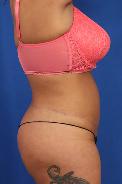 Abdominoplasty case #5196