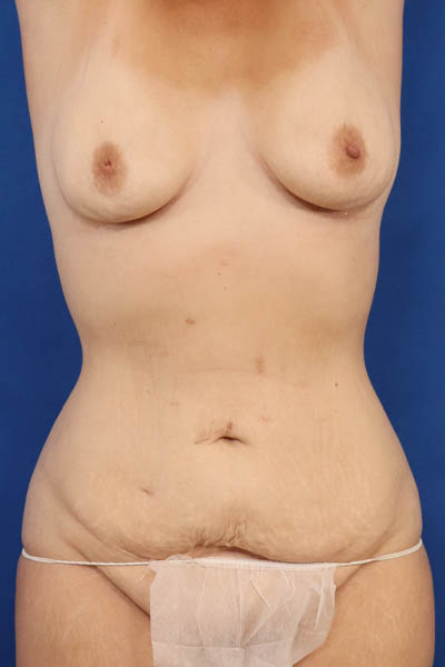Abdominoplasty case #5224