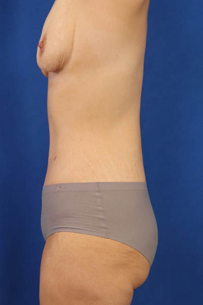 Abdominoplasty case #5224