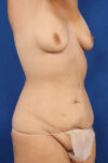 Abdominoplasty case #5224