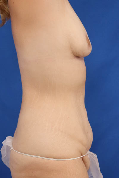Abdominoplasty case #5224