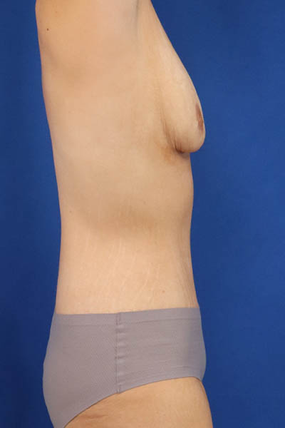 Abdominoplasty case #5224