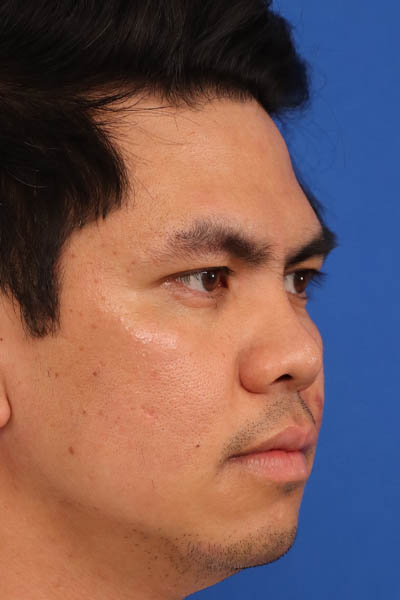 Rhinoplasty For Men case #5265