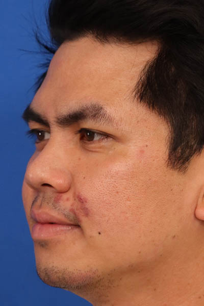 Rhinoplasty For Men case #5265